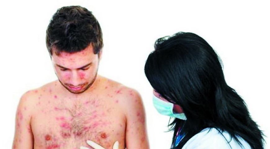 Первый завозной случай кори зарегистрирован в Могилеве