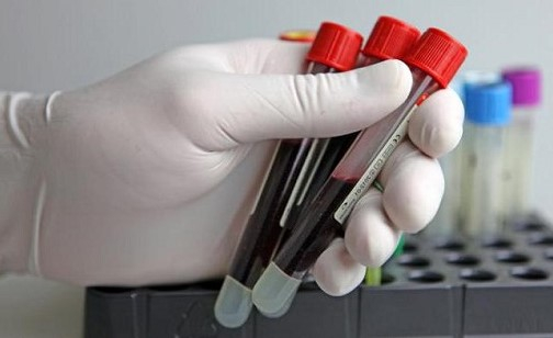 134 случая ВИЧ-инфекции выявлено в Могилевской области за 7 месяцев