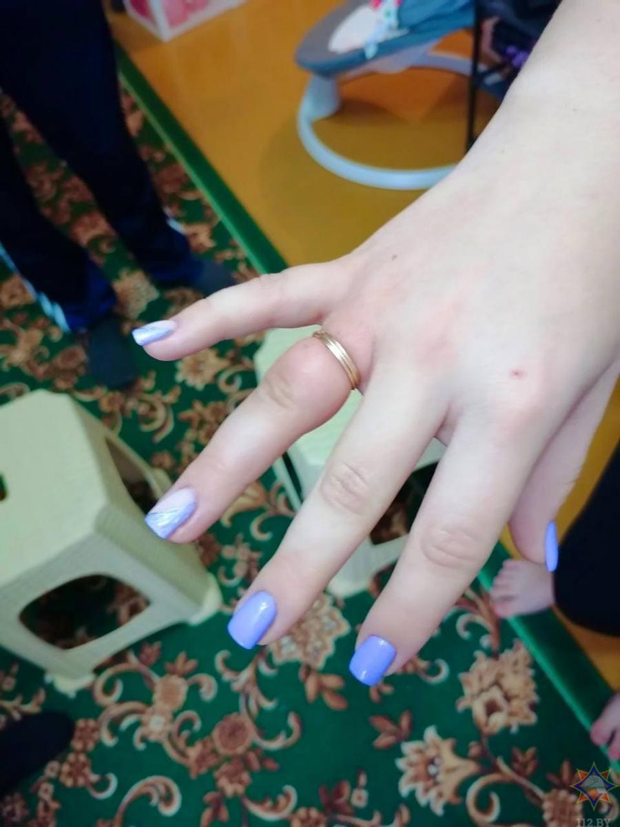 В Дрибинском районе спасатели помогли девушке снять кольцо с пальца