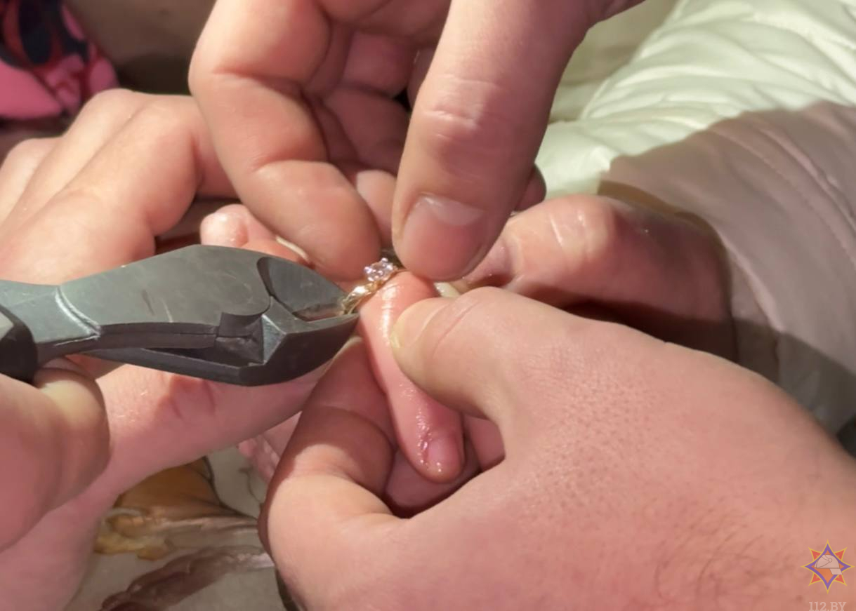 В Дрибинском районе спасатели помогли девочке снять застрявшее кольцо